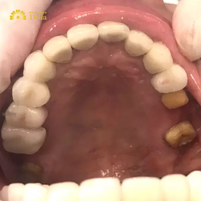 Răng sâu có tự rụng không? Hiểu đúng để chăm sóc răng miệng hiệu quả