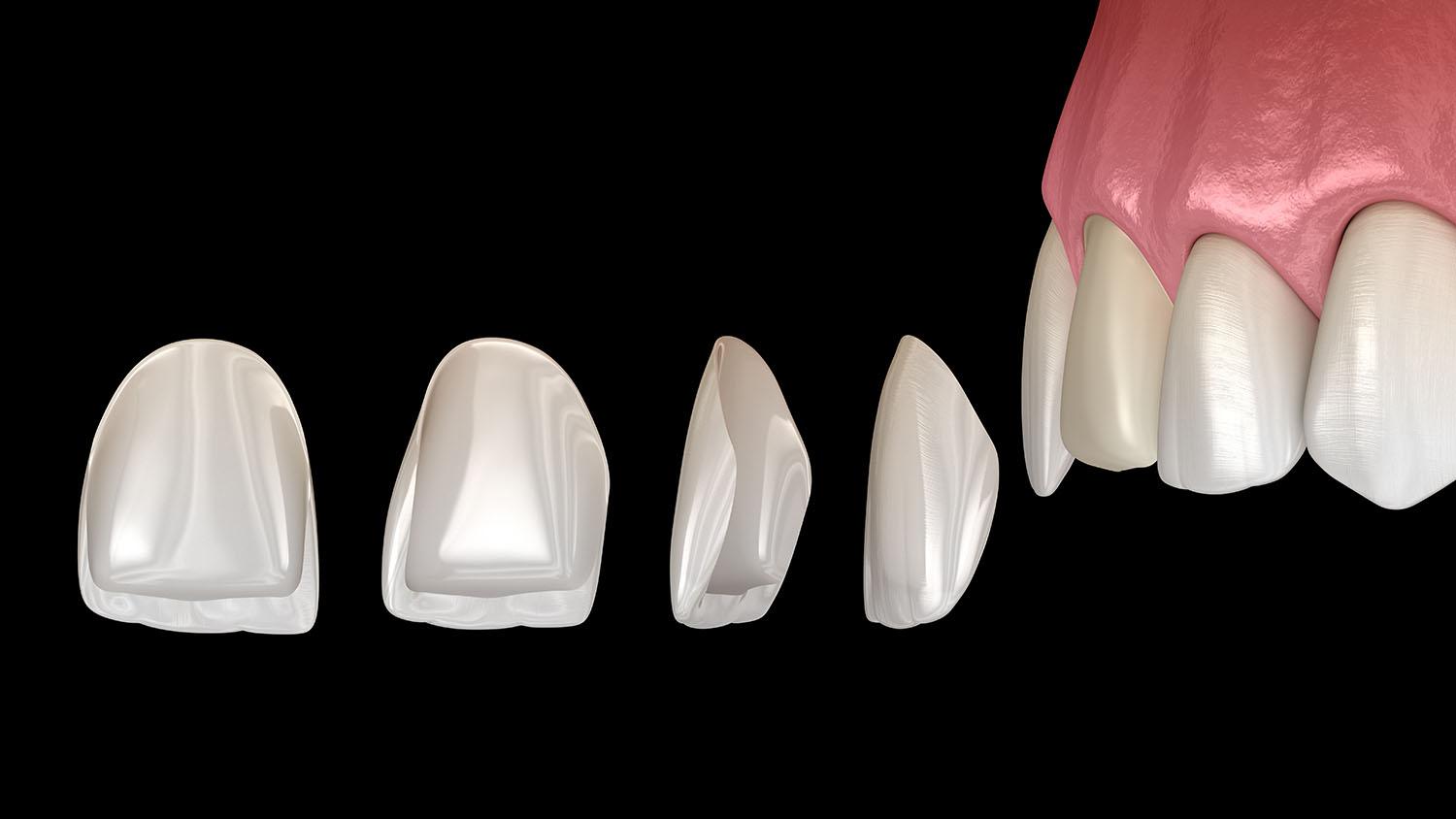 dental veneers in Toronto 