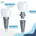 Cấu Tạo Răng Implant Hàn Quốc