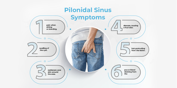 pilonidal sinus symptoms