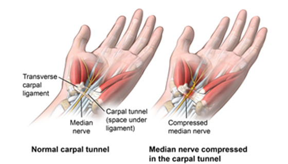 Best Tips to Avoid Carpal Tunnel from Gaming - 1-HP