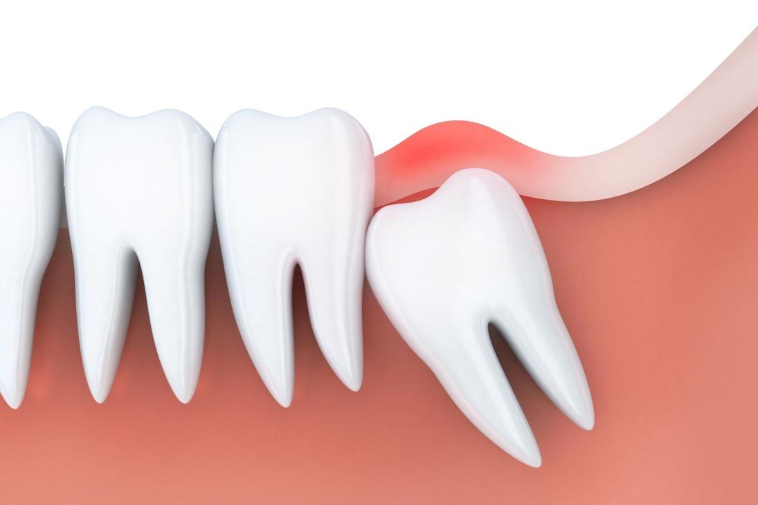 wisdom tooth removal in North York