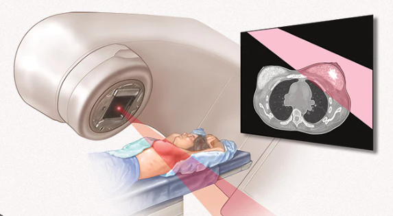 Treatment for Breast Basal Cell Carcinoma