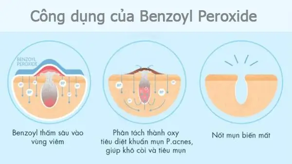 cong-dung-cua-benzoyl-peroxide