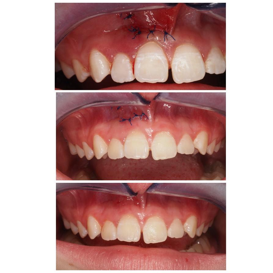 Obraz zawierający Ząb, zęby, usta

Opis wygenerowany automatycznie