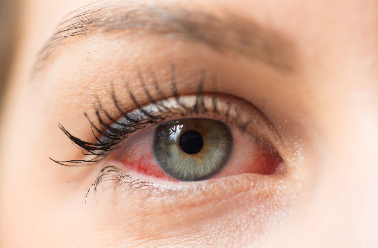 A close-up of bloodshot eyes.