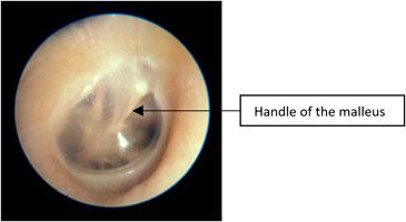 Normal Tympanic Membrane