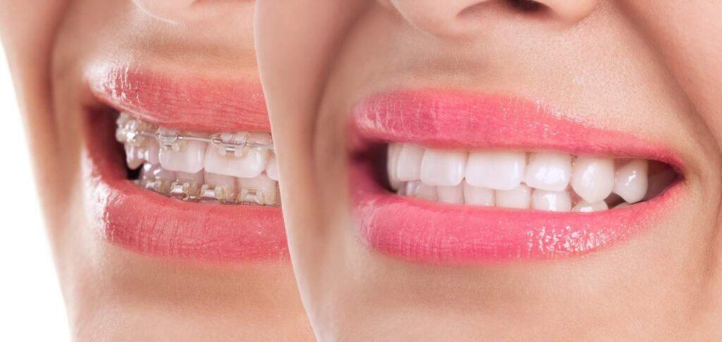 teeth whitening in Scarborough