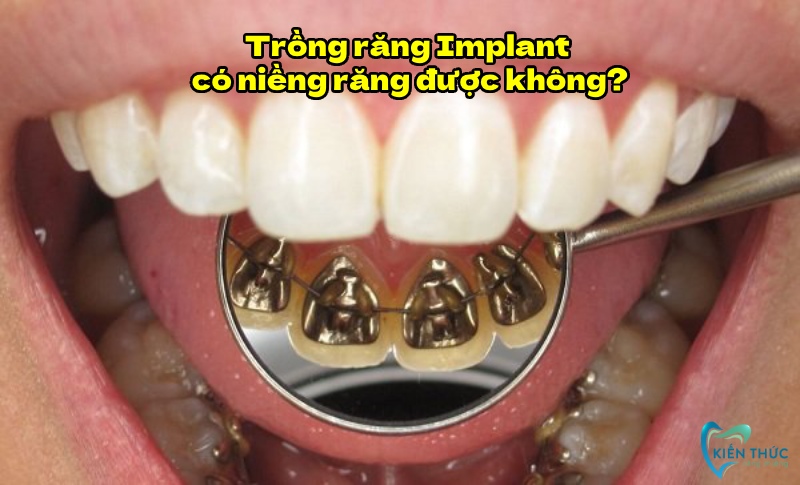 Trồng răng implant có niềng răng được không