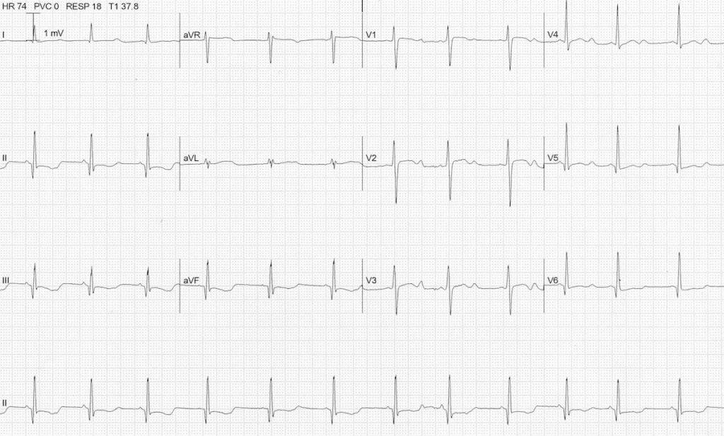 ECG severe hypokalemia serum potassium 1.9