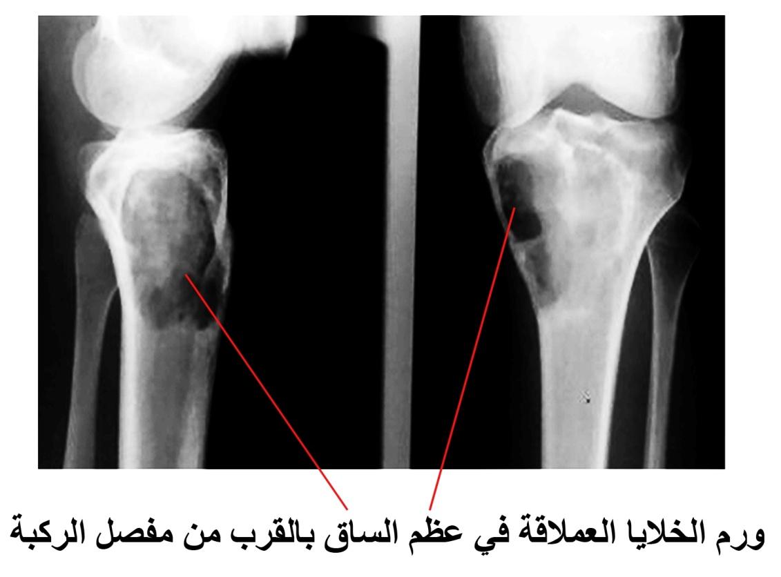 E:\Documents and Settings\USER\Desktop\Shared Files\bone cancer\خلايا عملاقة.jpg