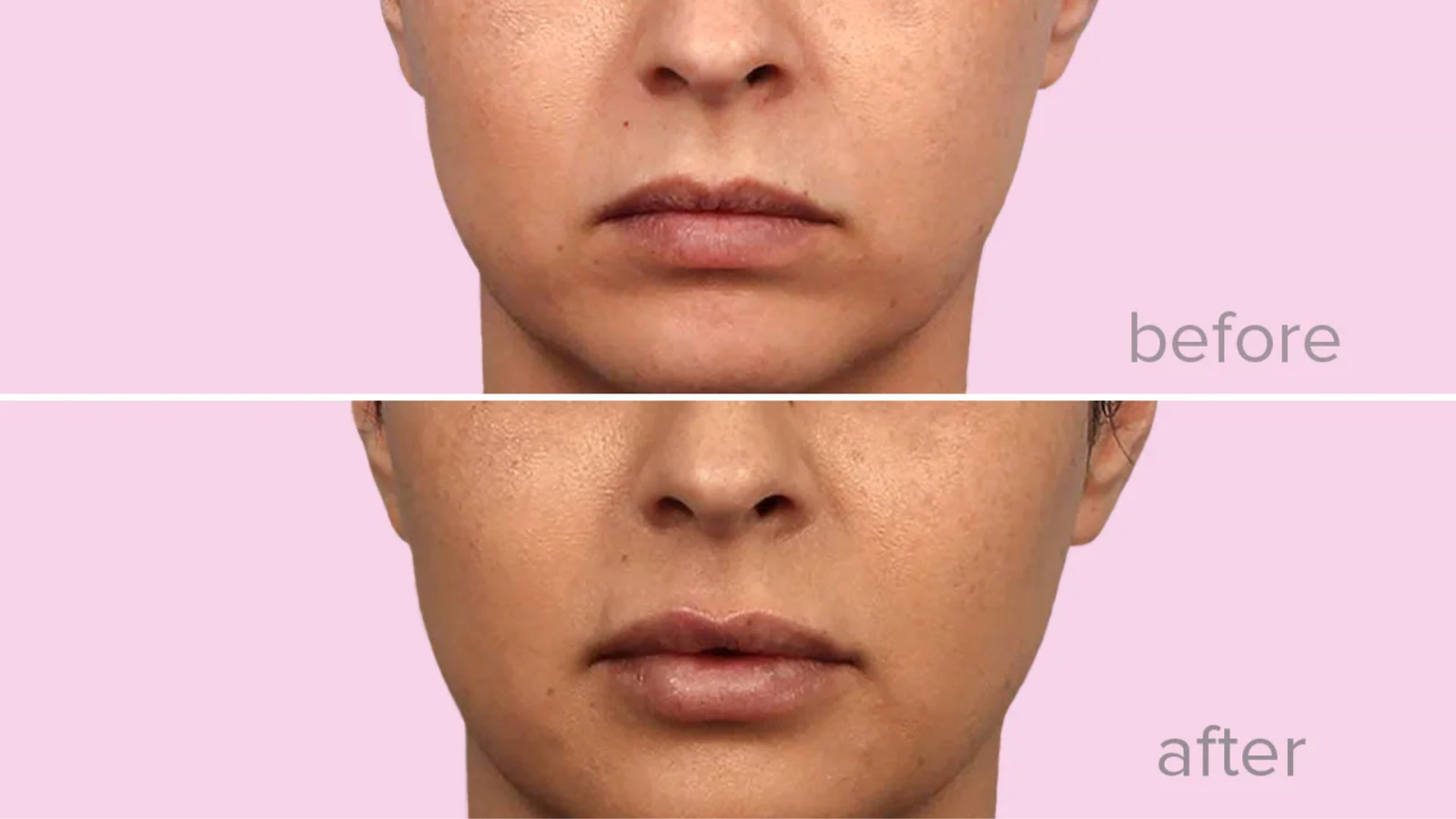 Before and after picture of Restylane Fillers