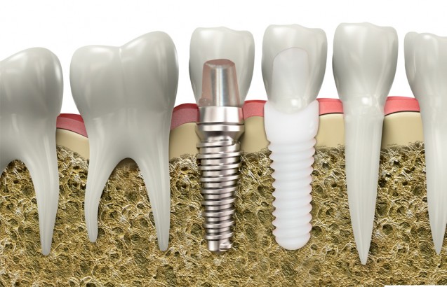 The difference between a titanium implant and a zirconia implant is shown. 