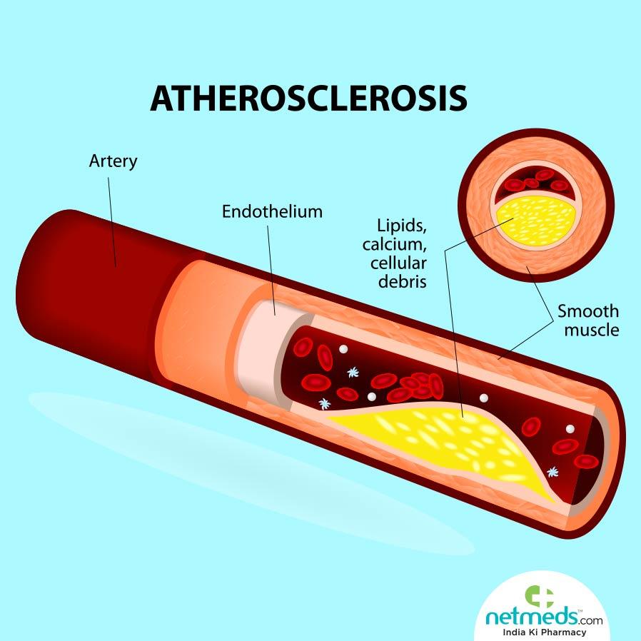 Atherosclerosis - Causes, Symptoms And Treatment | Netmeds