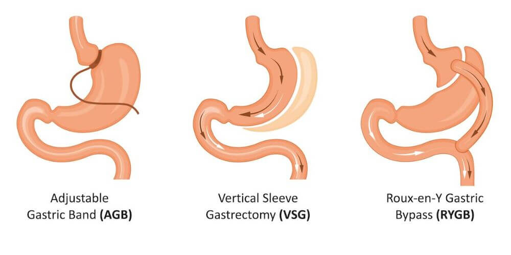 Différentes chirurgie bariatrique