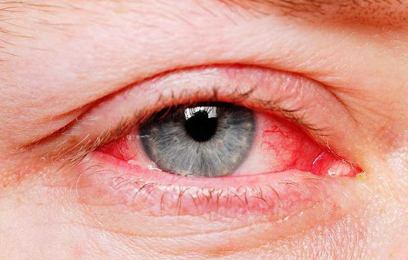 Thuốc nhỏ mắt Alegysal giúp dự phòng và điều trị tình trạng viêm kết mạc 