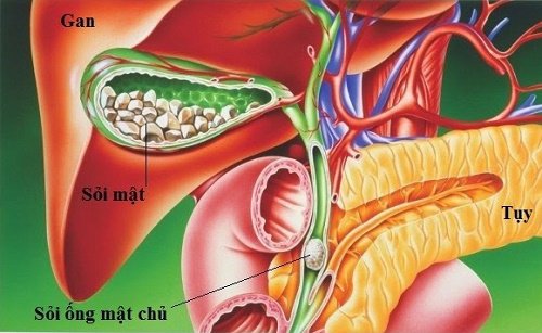 Sỏi đường mật trong gan do rối loạn chuyển hóa nội tiết