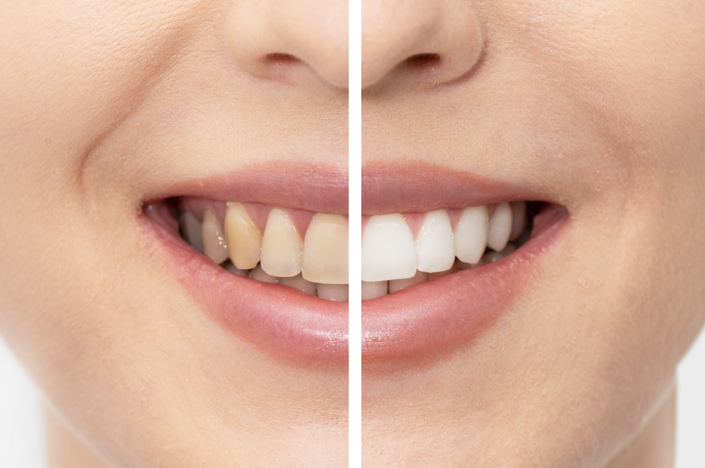 Before and after whitening