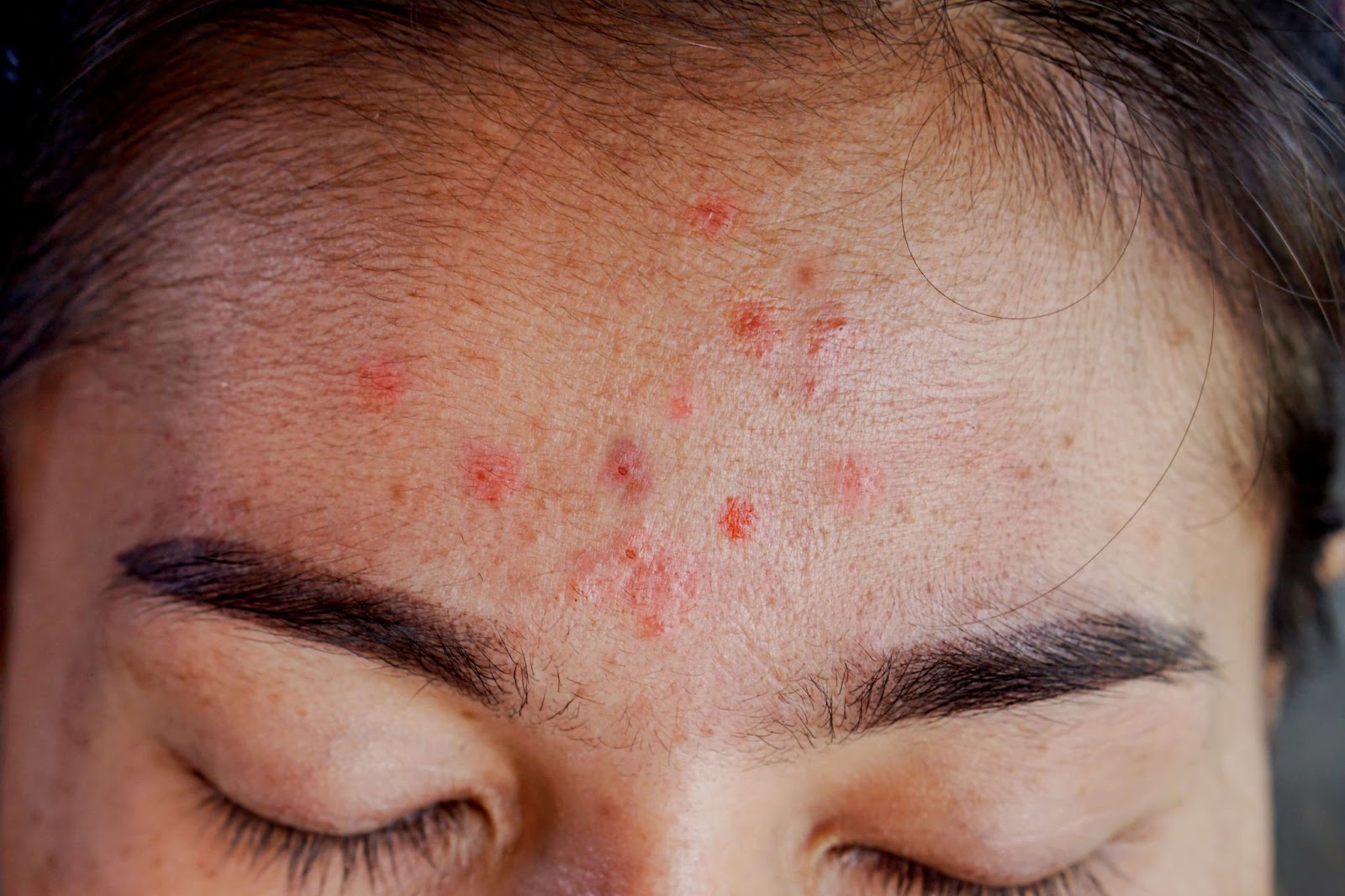 Sensitive, Acne-Prone Skin in Malaysia