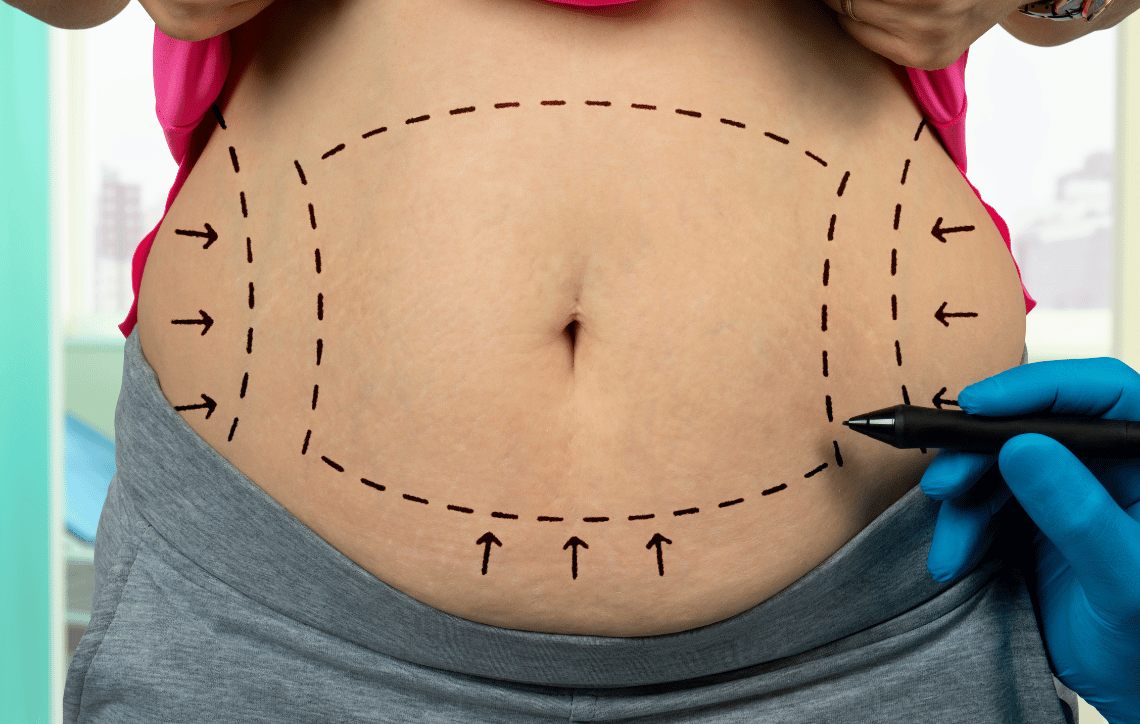 Belly removal lines