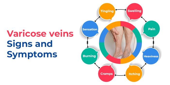 Varicose Veins Symptoms