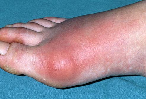http://www.herbal-ayurveda-remedy.com/home-remedies/images/PRinc_photo_of_inflamed_gout_toe.jpg