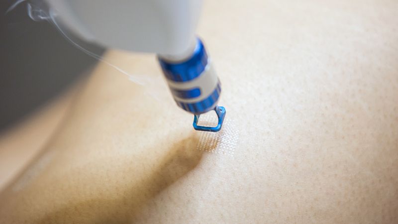 A CO2 laser working for laser skin resurfacing.