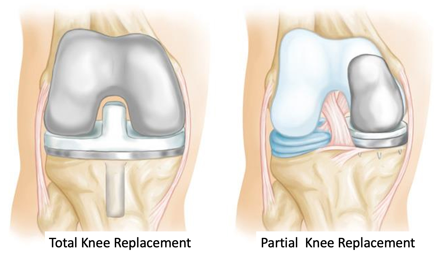 total-and-partial-knee-replacement