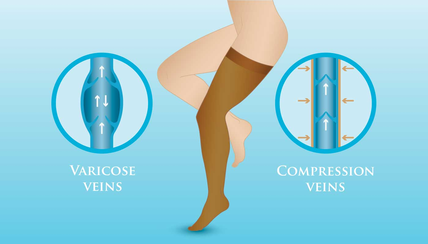 Compression Stockings for Varicose Veins: All You Need to Know