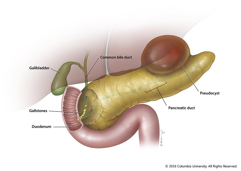 Pancreatitis | Columbia Surgery