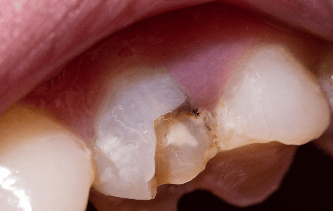 Emerging tooth