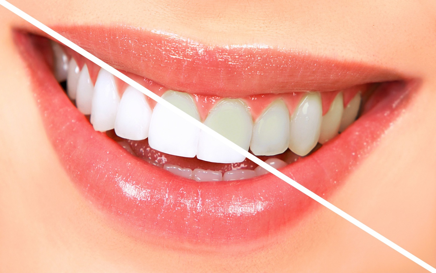 teeth whitening services in Richmond Hill 