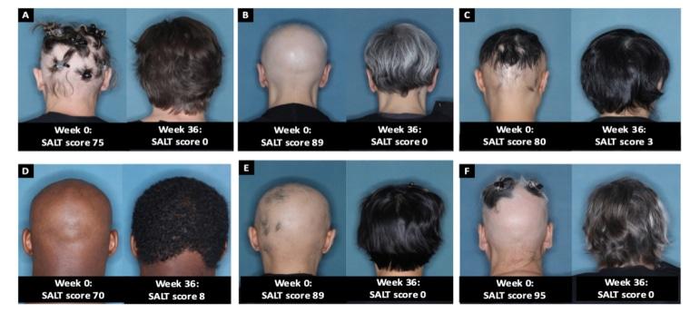 Two Phase 3 Trials of Baricitinib for Alopecia Areata.
