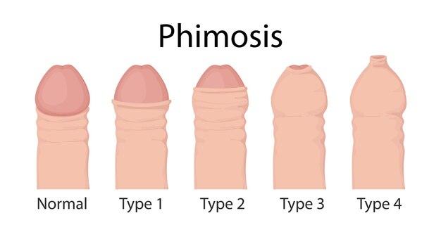 Vector types of phimosis penis medical vector illustration