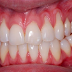 Nguyên nhân gây tình trạng tiêu xương răng và phương pháp trồng răng Implant cải thiện