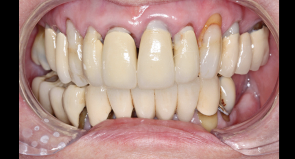 Receding gums and extra long teeth