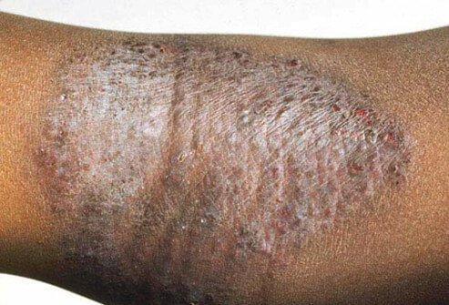 Eczema (Atopic Dermatitis) Causes, Symptoms, Treatment