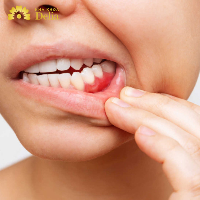 Bị chảy máu chân răng về đêm là dấu hiệu của bệnh gì? Nha khoa Delia