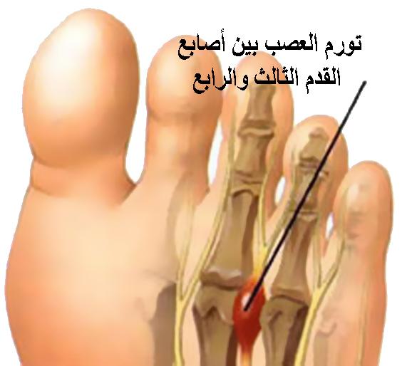 mortons_neuroma (1).jpg