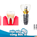 Tác động của viêm nha chu đến tích hợp trụ Implant Mỹ