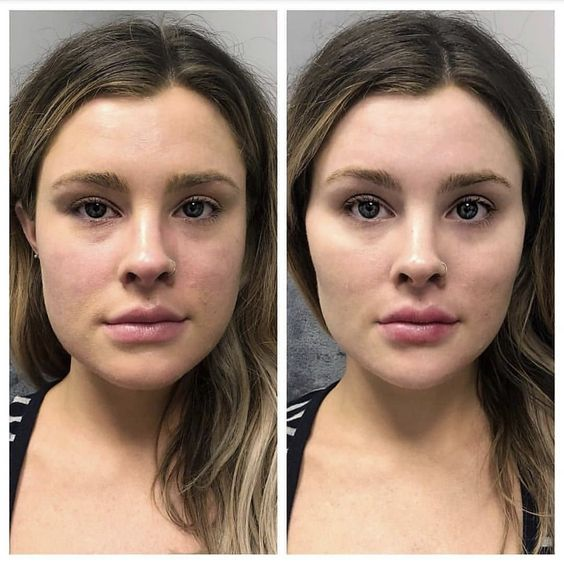 Side by side picture of the treatment