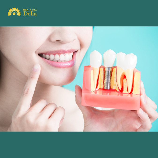 Lưu ý sau trồng răng Implant – Chăm sóc răng Implant đúng cách