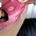 Ảnh Hưởng của Viêm Nha Chu và Viêm Niêm Mạc Miệng đối với Việc Trồng Răng Implant