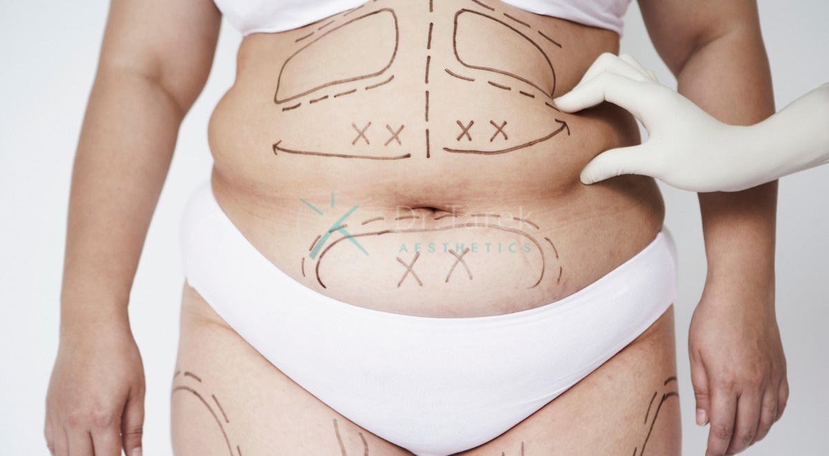 What Does Liposuction Cost