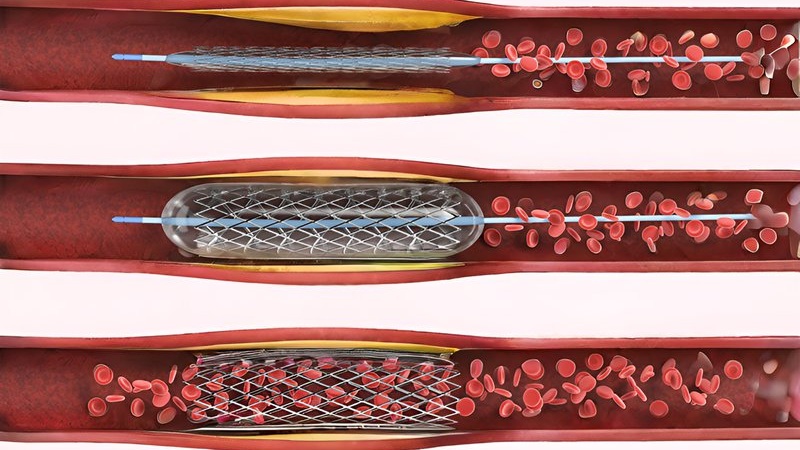 do-ben-cua-stent-mach-vanh-va-nhung-dieu-can-biet 1