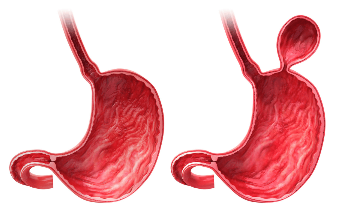 Stomach Hernia