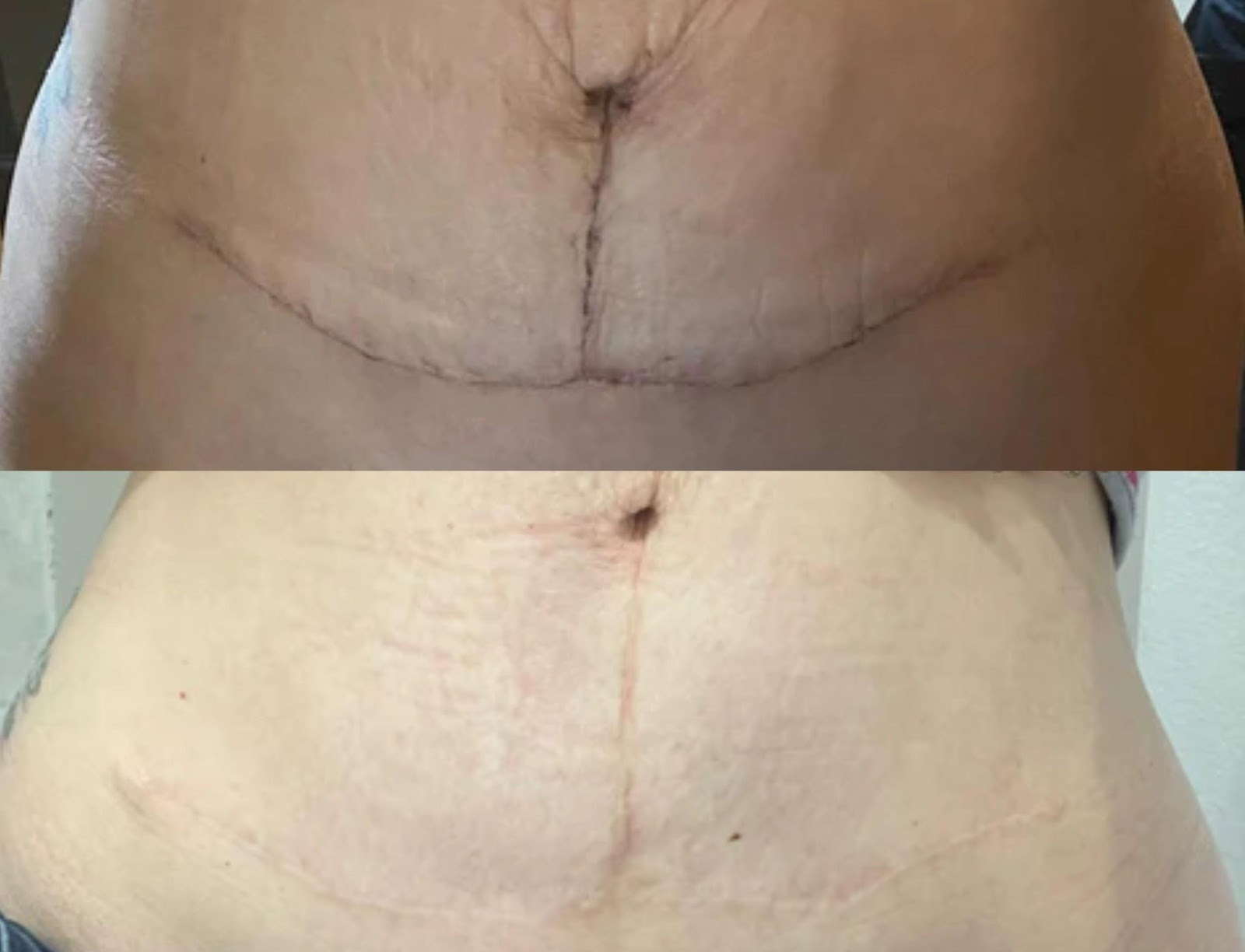 Qual é a aparência de uma cicatriz de abdominoplastia e quais são as suas variações?