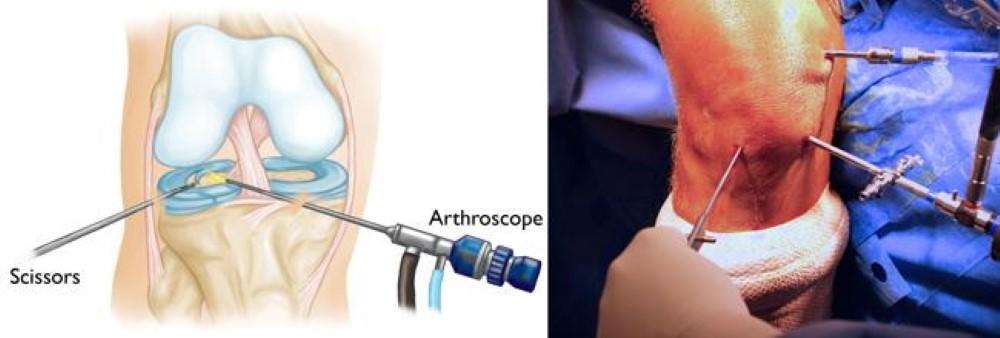 knee arthroscopy