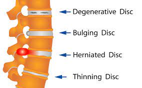 herniated disc - bulging disc