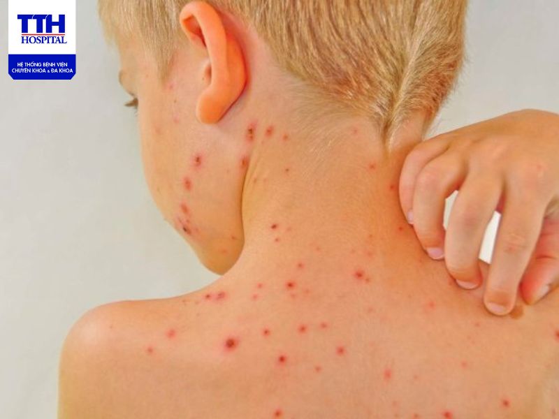 Lupus Ban Đỏ Hệ Thống Là Gì?